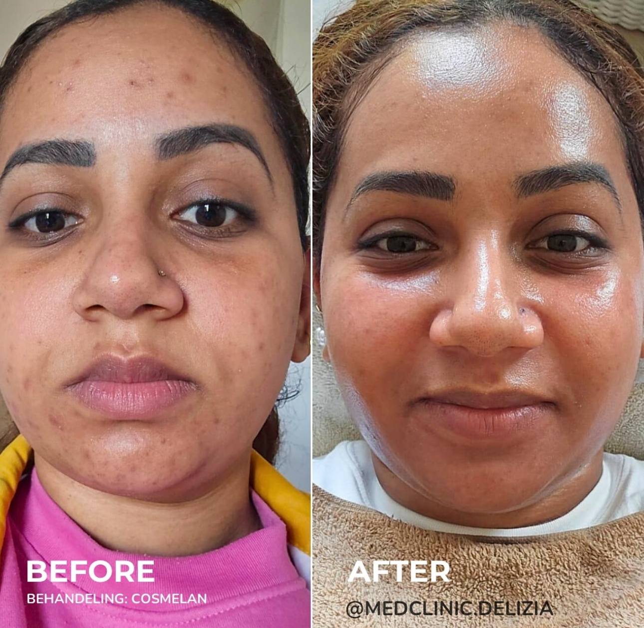 Voor/na: Cosmelan traject voor pigmentvlekken en teint-egaliteit
