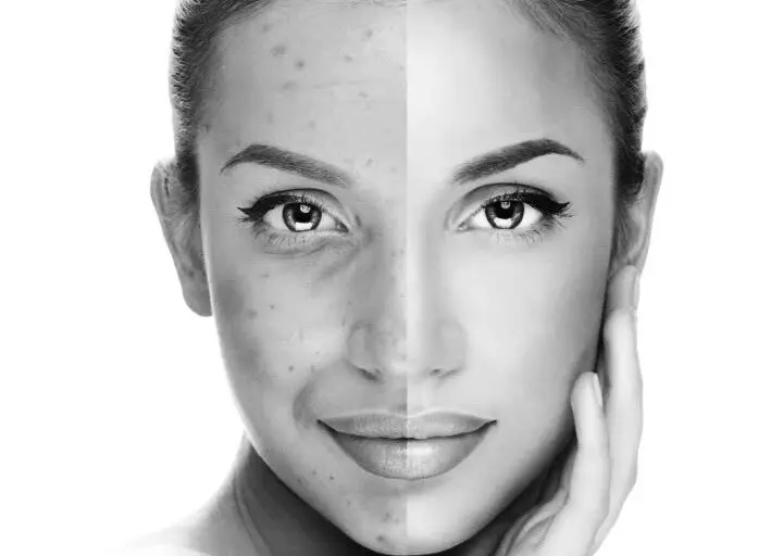 Voorbeeldresultaat van een gezichtsbehandeling bij Med-Clinic Antwerpen