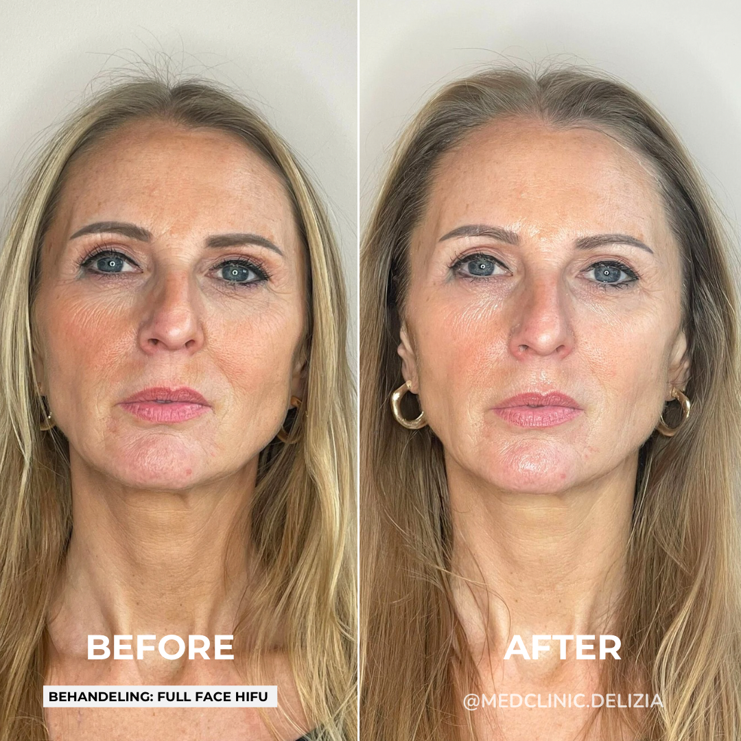 Voor/na: HIFU full face liften en contourverbetering