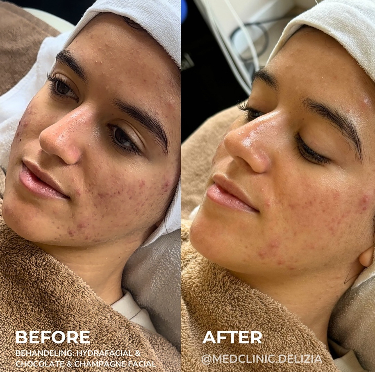 Voor/na: HydraFacial + Chocolate & Champagne facial bij onzuivere huid